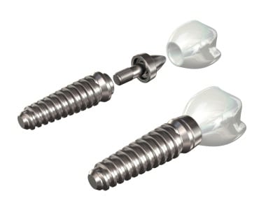 Benefits of dental implants in Salt Lake City